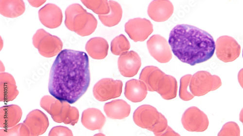 Microscopic image (photomicrograph) of a peripheral blood smear in a patient with acute lymphoblastic leukemia (ALL) showing two  blast cells (lymphoblasts) photo