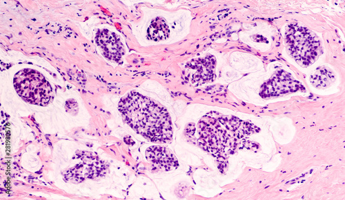 Breast cancer histology (core biopsy): Microscopic image (photomicrograph) of mucinous carcinoma, wth clusters of tumor cells floating in a sea of mucin.  Detected by screening mammogram. H & E stain. photo