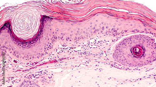 Konstfotografi Skin biopsy of an actinic (solar) keratosis, common on sun-damaged skin and a precursor of squamous cell carcinoma (cancer)