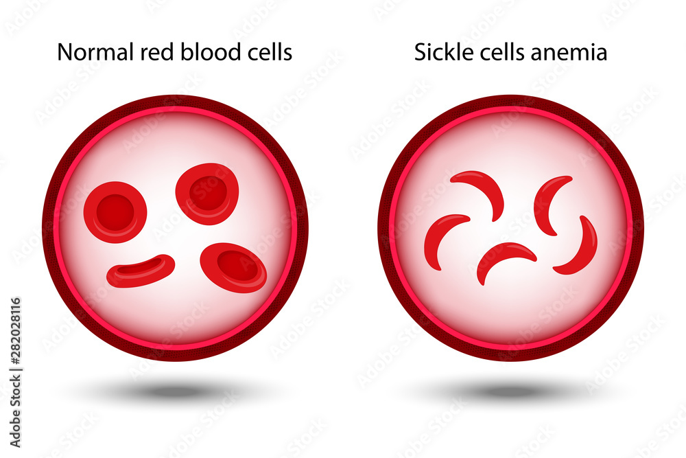 Comparison between Normal red blood cells and Sickle cells anemia in ...