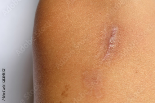 Scar on the legs of women. cosmetology concept.