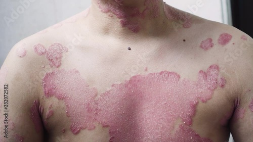 A man with psoriasis on his chest. Scratch with his hand. Bad case.