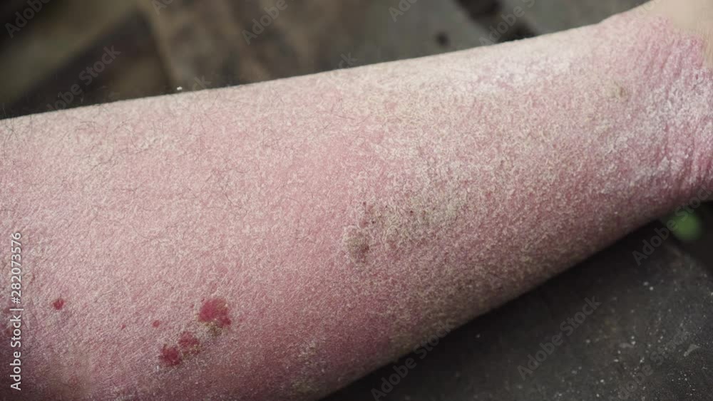 A man with psoriasis on his leg and foot with some wound from scratch. Very bad case. A man with psoriasis on his leg and foot with some wound from scratch. Very bad case.