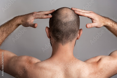 The concept of male alopecia and hair loss. Rear view, a man holding his hands over his head with a bald spot photo