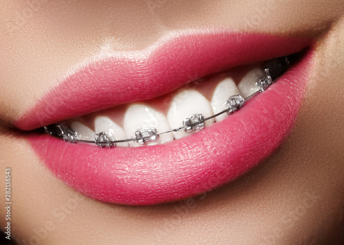 Beautiful White Teeth with Braces. Dental Care Photo. Woman Smile with Ortodontic Accessories. Orthodontics Treatment