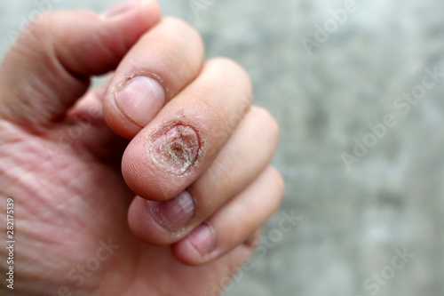 Close up of fungus nail infection. Fungal infection on nails hand, finger with onychomycosis, damage on human hand on gray concrete wall background. Disease and Symptom concept. © narin_nonthamand