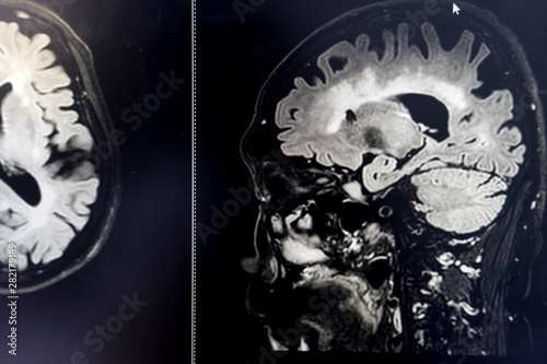 brain MRI for education Dementia Mix type stroke VaD