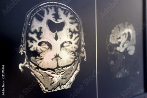 Quadro su tela brain MRI for education Dementia Mix type stroke VaD