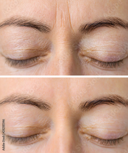 Woman's face skin before and after aesthetic beauty cosmetic procedures with removed skin wrinkles photo