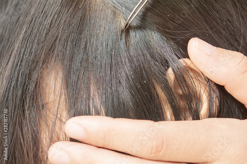 Lice in hair and comb on white background