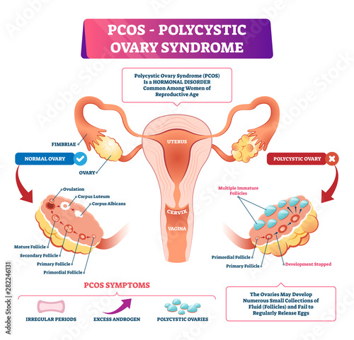 Polycystic ovary syndrome vector illustration. Labeled reproductive disease photo