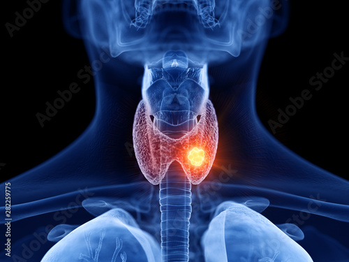 3d rendered medically accurate illustration of thyroid cancer