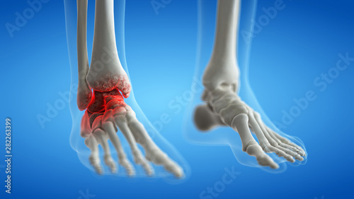 3d rendered medically accurate illustration of an arthritic ankle joint