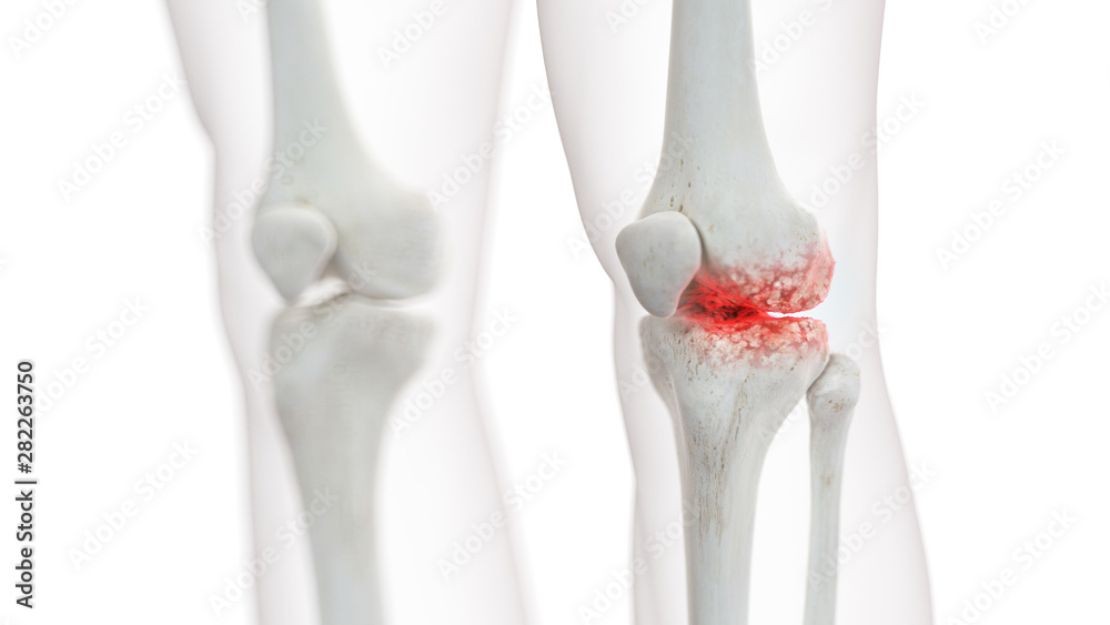 3d rendered medically accurate illustration of an arthritic knee joint 3d rendered medically accurate illustration of an arthritic knee joint