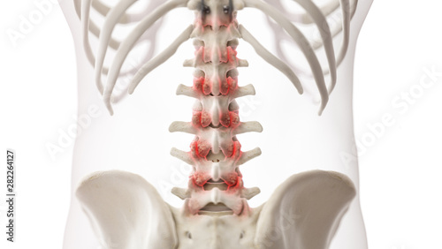 Schilderij op canvas 3d rendered medically accurate illustration of an arthritic lumbar spine