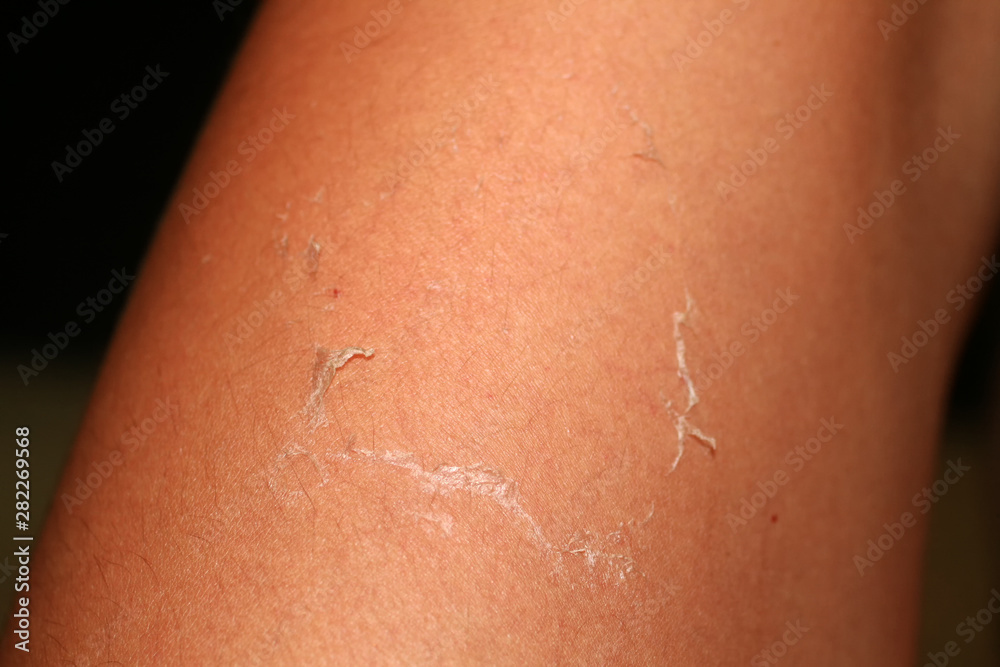 Peeling skin. Burn on the skin from sun tanning 282269568 Wzory