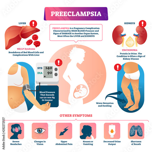 Preeclampsia vector illustration. Labeled pregnancy complication scheme. photo