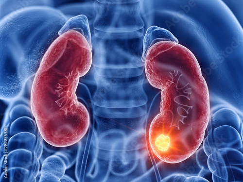 3d rendered medically accurate illustration of kidney cancer photo