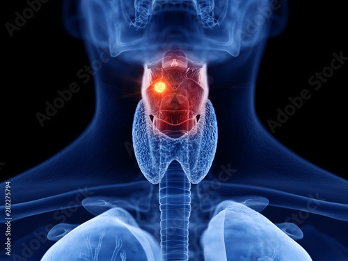 3d rendered medically accurate illustration of larynx cancer