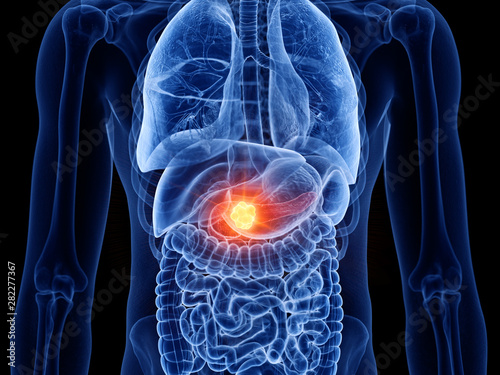 3d rendered medically accurate illustration of pancreas cancer photo