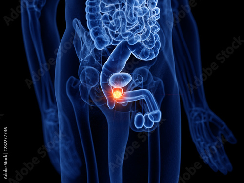 3d rendered medically accurate illustration of prostate cancer