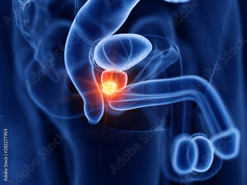 Bild auf Leinwand 3d rendered medically accurate illustration of prostate cancer