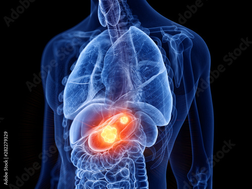 Foto 3d rendered medically accurate illustration of stomach cancer