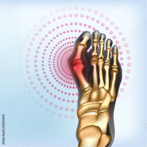 Bunion Foot deformation Realistic bones of foot