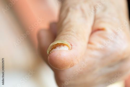 nail with advanced fungal disease photo