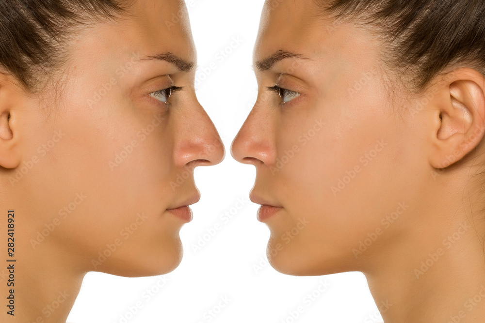 beuatifull young woman before and after nose surgery beuatifull young woman before and after nose surgery