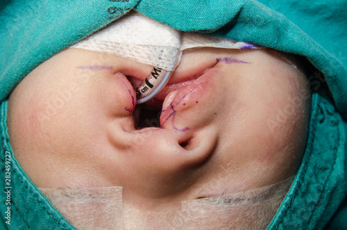 Принти на полотні Surgeon in hospital surgery for treatment about Cleft lip cleft palate in operating room at the hospital