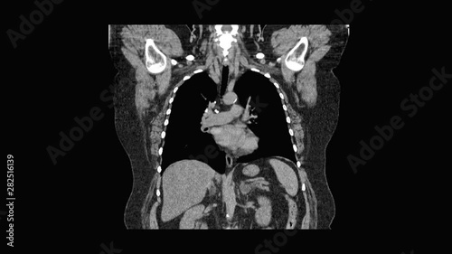 MRI scan of the lungs and bronchi, diagnosis of respiratory diseases