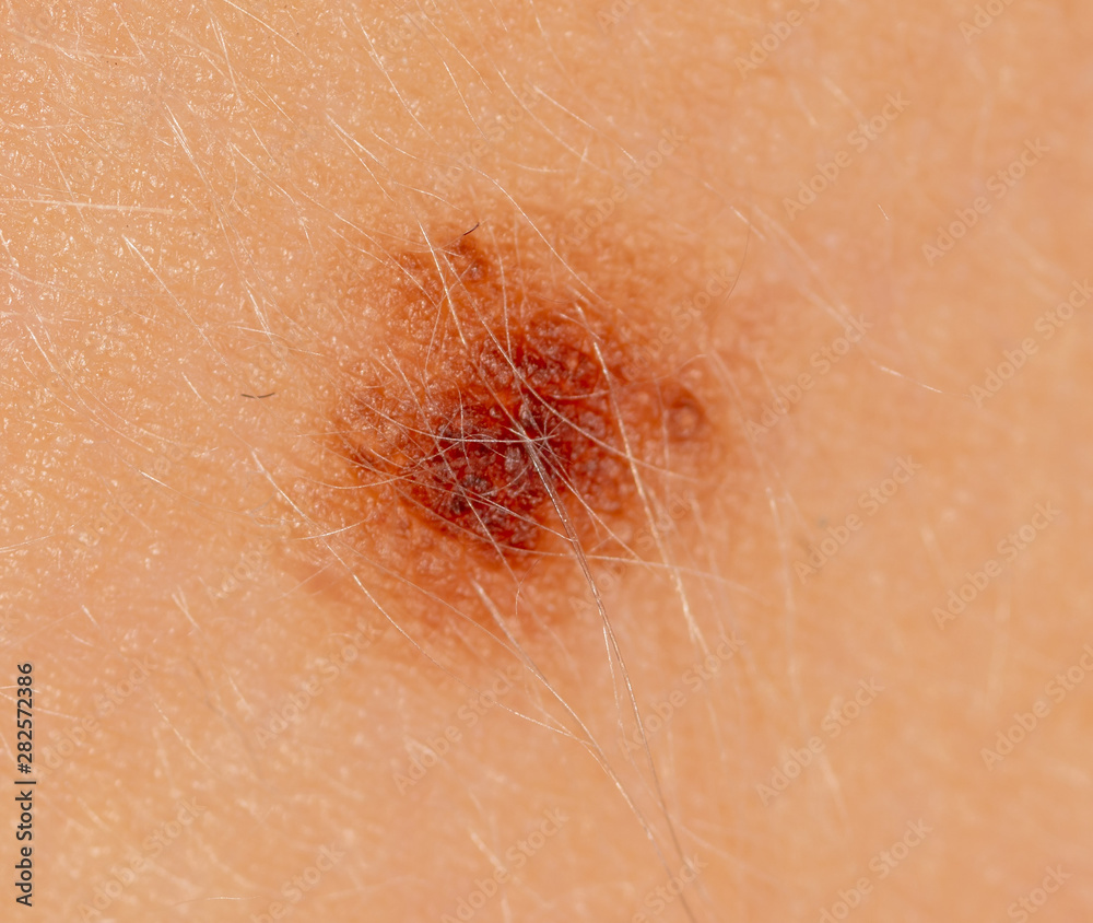 Fototapeta premium Birthmark on human skin as a background