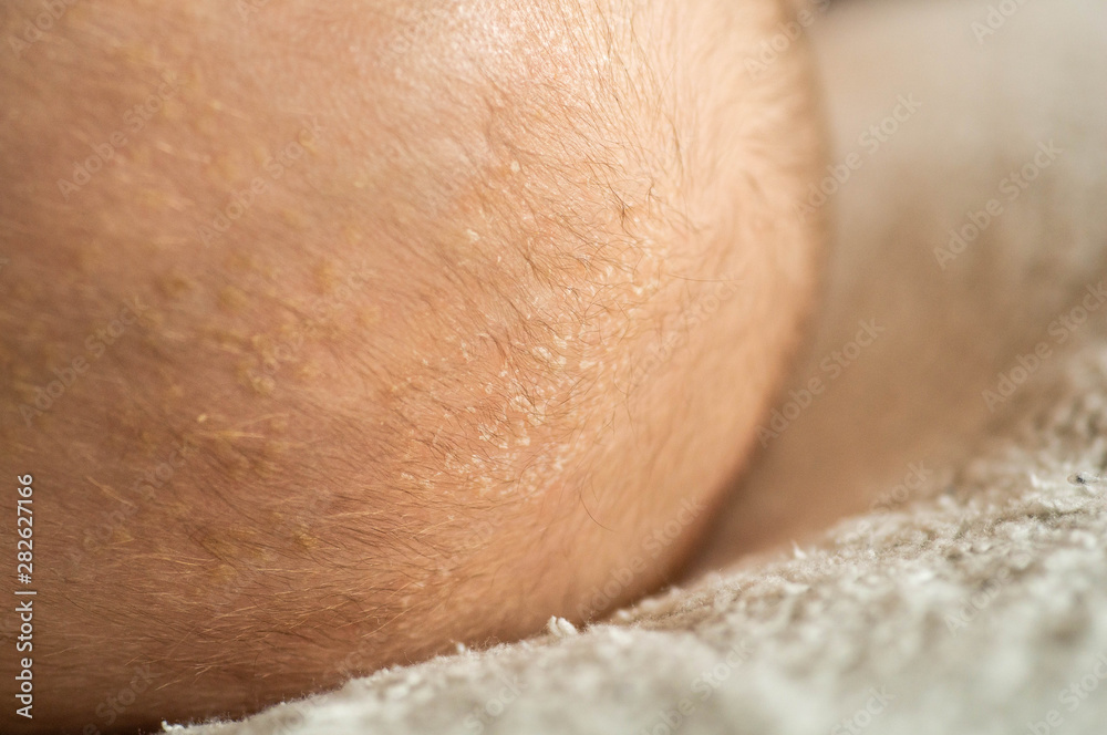 Baby crust on the head. Seborrheic crust on baby head, closeup