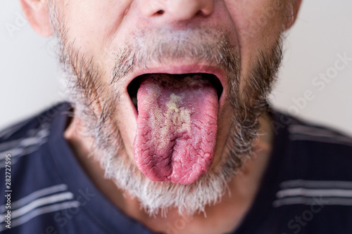 bacterial tongue disease in an older man