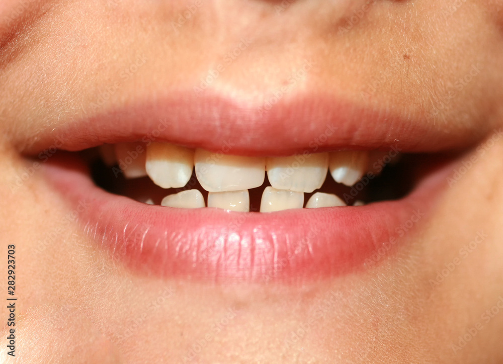 Obraz premium Incorrect bite in a child. Malocclusion in children. Crooked teeth.