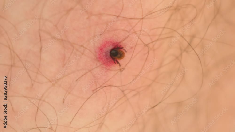 Macro close-up of a tick embedded in a person's skin after it has burrowed and is feeding on human blood