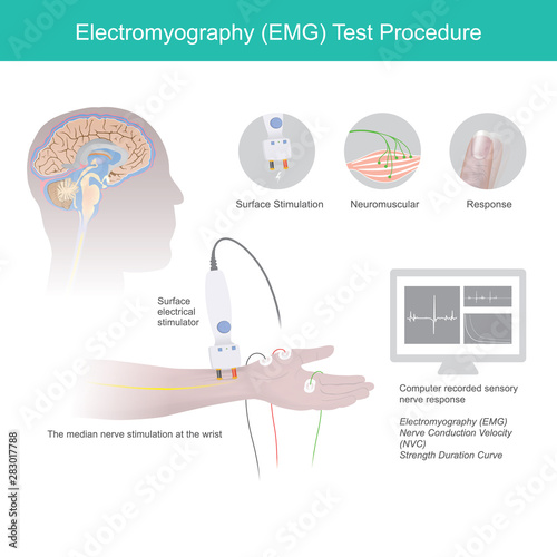 Electromyography Test Procedure.