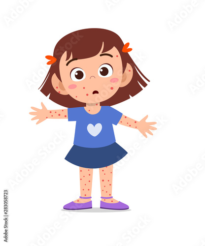 kid girl having chicken pox vector