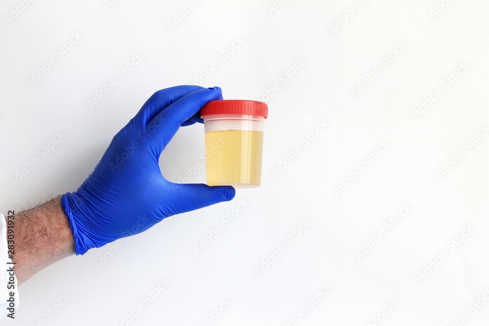 Doctor's hand in glove holding urine specimen medical analysis. Urine