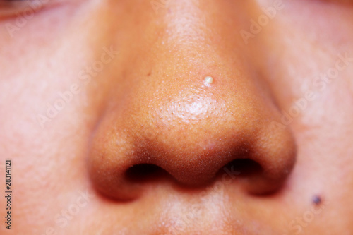 Pimple of Nose