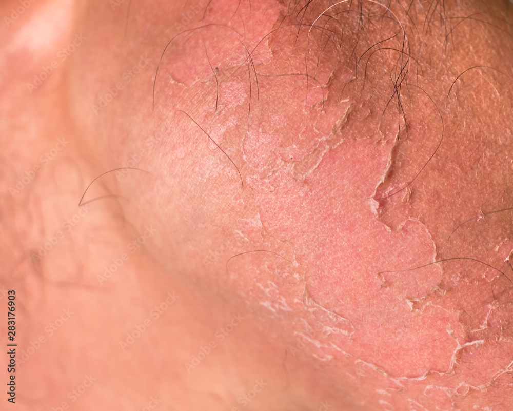 Fototapeta premium Small detail of a sunburned peeling