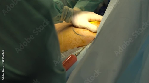 Hands of a surgeon with a syringe, injector. Surgeon making lipofilling in surgical room photo