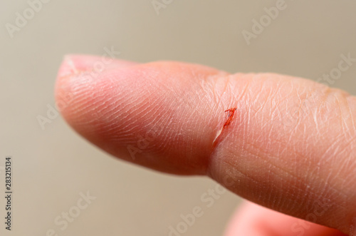 Open cut wound on the index finger