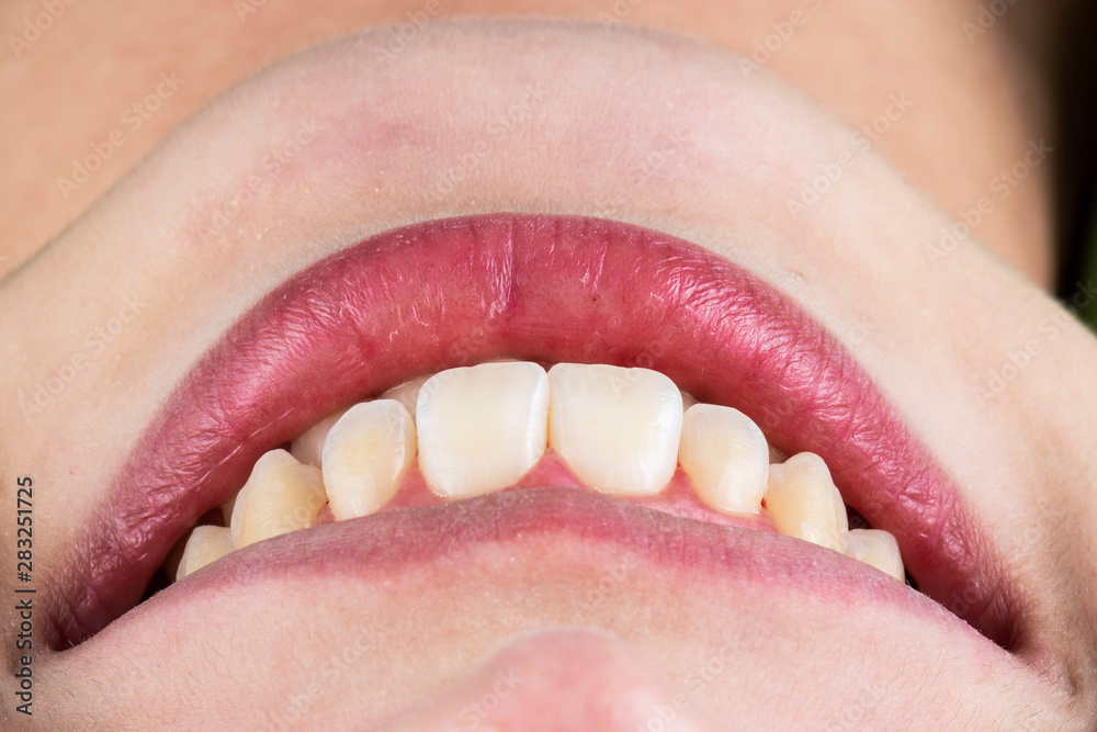 Fototapeta premium natural look ceramic veneers photoes