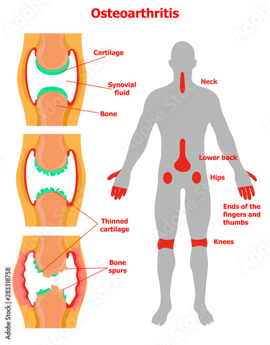 Stages of osteoarthritis and some joints that are commonly affected