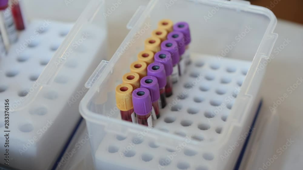 Close-up of medical blood samples in tubes being placed in a tray for testing Close-up of medical blood samples in tubes being placed in a tray for testing