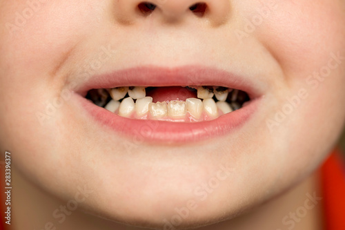 Kid patient open mouth showing cavities teeth decay. Close up of unhealthy baby teeth. Dental medicine and healthcare - human patient open mouth showing caries teeth decay