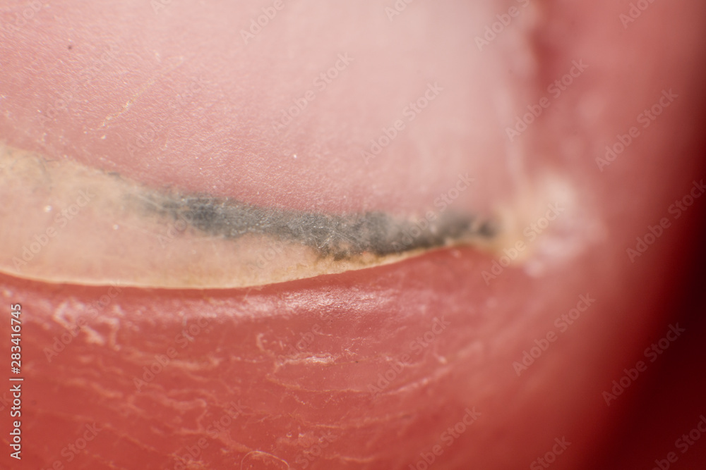 Fototapeta premium Dirt stuck under the man nail super macro
