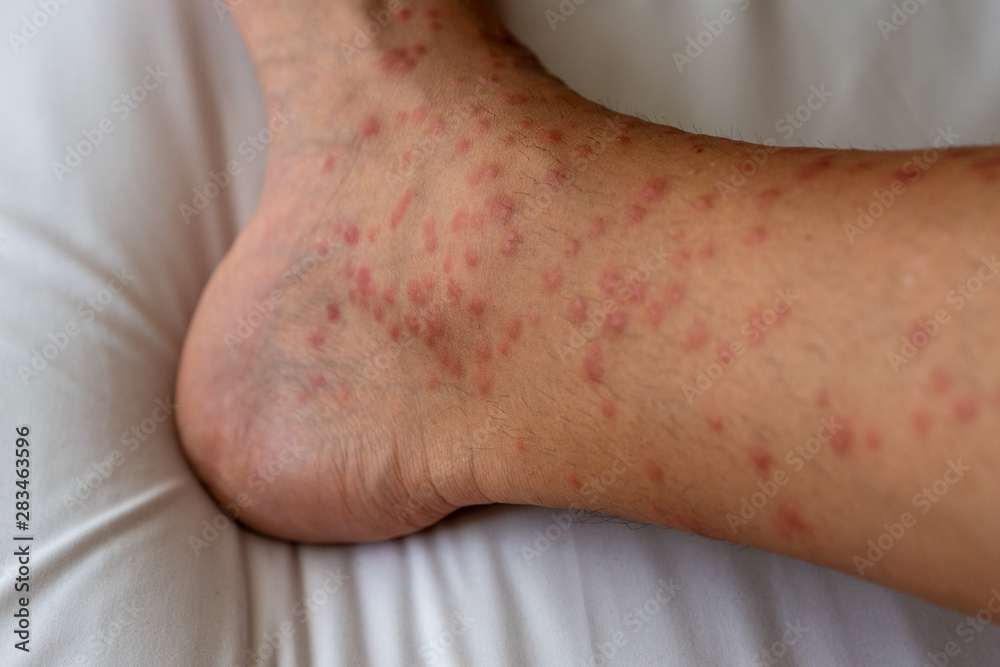 Close up of redness, itching and swelling after many mosquitos bite on the leg - allergy to mosquito saliva can cause papular hives or Skeeter's syndrome Close up of redness, itching and swelling after many mosquitos bite on the leg - allergy to mosquito saliva can cause papular hives or Skeeter's syndrome